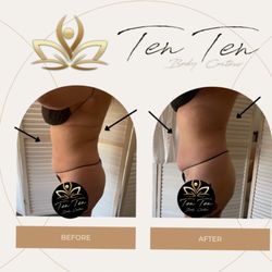 Ten Ten Body Contour - Wood Therapy, Ultrasonic Cavitation, Radio Frequency