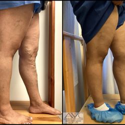 Advanced Vein Center - Before & After