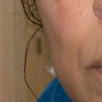 Flora Permanent Beauty Center - permanent scarring from a treatment done by this esthetician who was not licensed to use the laser machine that she used. - Skin Care Near Me - San Francisco, California Flora Permanent Beauty Center - permanent scarring from a treatment done by this esthetician who was not licensed to use the laser machine that she used. - Skin Care Near Me - San Francisco, California