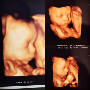 4D Miracles - 32 weeks - Ultrasound Imaging Centers Near Me - Fremont, California 4D Miracles - 32 weeks - Ultrasound Imaging Centers Near Me - Fremont, California