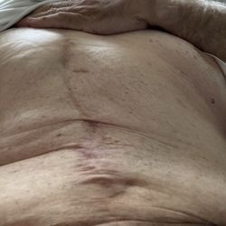 Richard A Marfuggi, MD - Tummie tuck