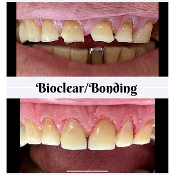 Richard R Walker,DDS - Bioclear/bonding with no tooth reduction and minimal patient out of pocket cost after insurance - General Dentistry Near Me - Chehalis, Washington