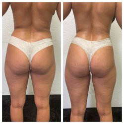 Hour Glass By Jluney - Butt vaccum therapy. Cellulite has decreased and buttt has lifted and plumped.