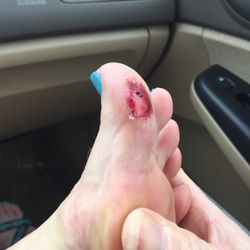 Nail Focus - This is the state of my mother's toe upon leaving. Seriously, be careful.