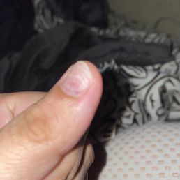 The bruise in the button left hand corner of nail The bruise in the button left hand corner of nail