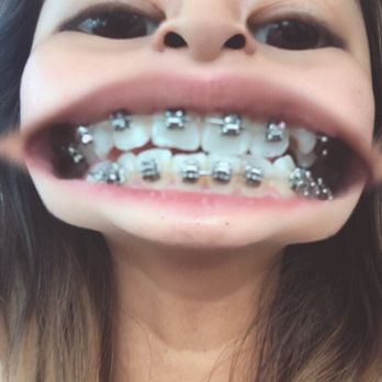 Gilmore Orthodontics - Before - Orthodontists Near Me - San Diego, California