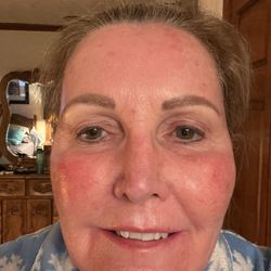 Dermatology Center - Prior to the laser treatment About week 3.5 with ZO