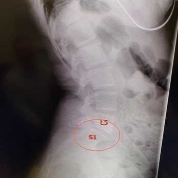 Temecula Disc Center - Nerve got jammed by l5 joint - Chiropractors Near Me - Temecula, California