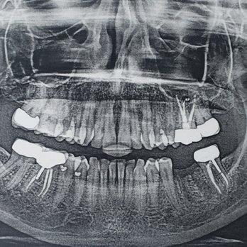 Iconic Dental - 14 is now gone as well due to failed root canal retreatment and sinus perforation and left behind roots absessed ongoing from orig rt canal. - General Dentistry Near Me - Phoenix, Arizona