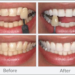 Pearly Lights teeth whitening - Actual results!!!!!