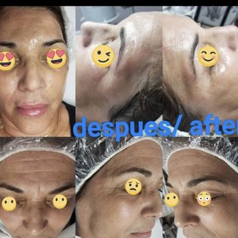 Facial Care With Yusi - Plasma microneedling - Skin Care Near Me - Miami, Florida Facial Care With Yusi - Plasma microneedling - Skin Care Near Me - Miami, Florida