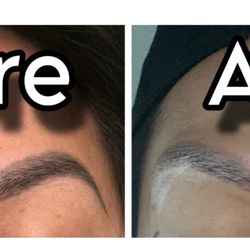 Freedom Laser Hair and Tattoo Removal - Before and directly after 1st session