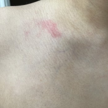 Infinite Nails & Spa - Burn mark from the hot pillow on/near my collar bone - Nail Salons Near Me - Houston, Texas Infinite Nails & Spa - Burn mark from the hot pillow on/near my collar bone - Nail Salons Near Me - Houston, Texas