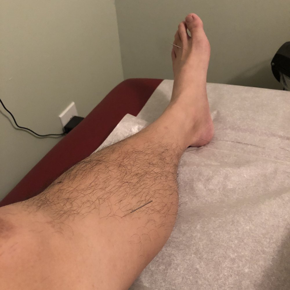 Joy Acupuncture - relief for leg muscles - Acupuncture Near Me - Roslyn Heights, New York