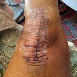 Bruising in first few weeks!
