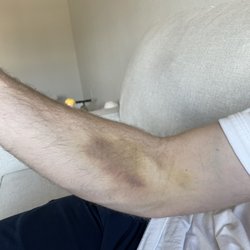 Quest Diagnostics - Bruise from poor execution when drawing blood.