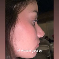 Aoc - 18 month post op