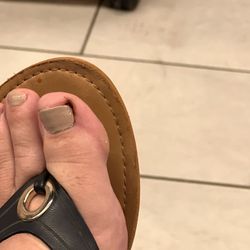 Montano Nails - Injured toe