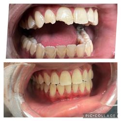 Leslie Azran, DDS - BH Dental - Anterior teeth repaired with composite veneers