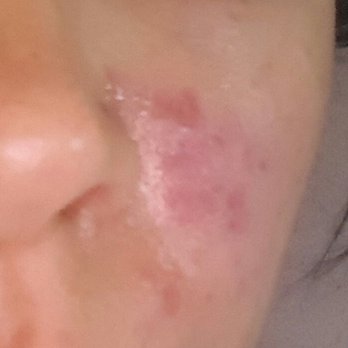 Clarity Spa - DAMAGED and TORN SKIN from her treatments. She DOES NOT know what she is doing!!! - Skin Care Near Me - League City Tx, Alabama