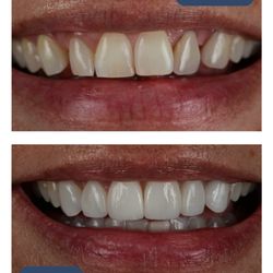 Blyss Dental - Before/After Transformation Photo

- "Imagine a smile transformation. Schedule your free consultation today!"