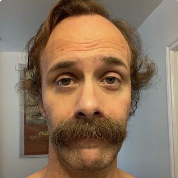 Marc Dauer, MD - 1 year after. - Cosmetic Surgeons Near Me - New York, New York