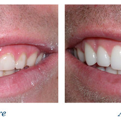 Gentle Dental - Before and After, Veneers for a cosmetic upgrade :)