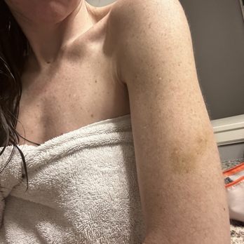 El Heffe - Bruising from assault 5 days later! - Mexican Near Me - Scottsdale, Arizona