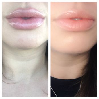 VIP Plastic Surgery - Lips 10 days after injections and before!!! - Cosmetic Surgeons Near Me - Henderson, Nevada