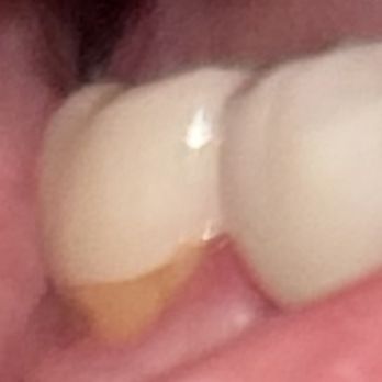 Aspen Dental - Lake Worth, TX - The exposed area between the crown and the gun line. It is very painful. - General Dentistry Near Me - Lake Worth, Texas Aspen Dental - Lake Worth, TX - The exposed area between the crown and the gun line. It is very painful. - General Dentistry Near Me - Lake Worth, Texas