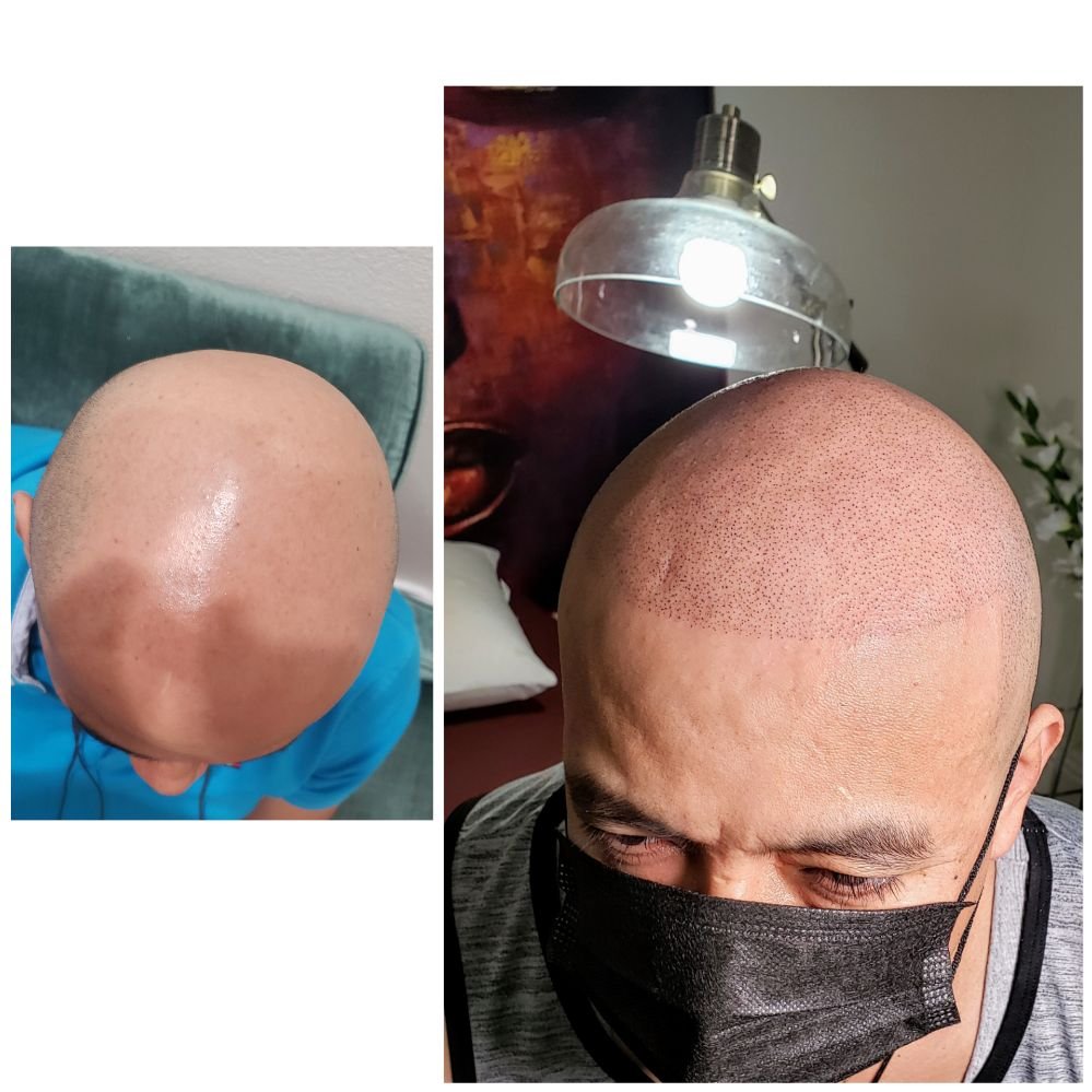Hairline SMP Logo