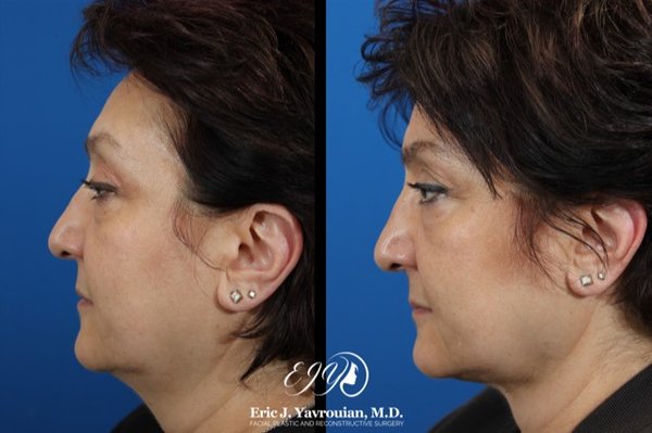 FaceTite - FaceTite is one of the latest advances in skin tightening and is quickly becoming a popular scarless treatment for anyone who wants to look years younger. Unlike other skin tightening treatments out there, FaceTite uses Radio-Frequency Assisted Lipolysis (RFAL) to break down excess fat and then a thin cannula is inserted into the skin. This cannula, combined with an external electrode, creates thermic energy in the tissue which triggers collagen production. FaceTite - FaceTite is one of the latest advances in skin tightening and is quickly becoming a popular scarless treatment for anyone who wants to look years younger. Unlike other skin tightening treatments out there, FaceTite uses Radio-Frequency Assisted Lipolysis (RFAL) to break down excess fat and then a thin cannula is inserted into the skin. This cannula, combined with an external electrode, creates thermic energy in the tissue which triggers collagen production.