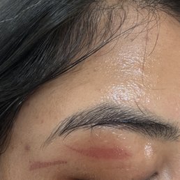 Skin burn after waxing Skin burn after waxing