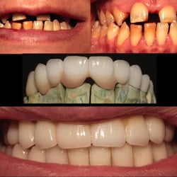 Cabo Dental Solutions - Old teeth (top) New teeth (mid & bottom)