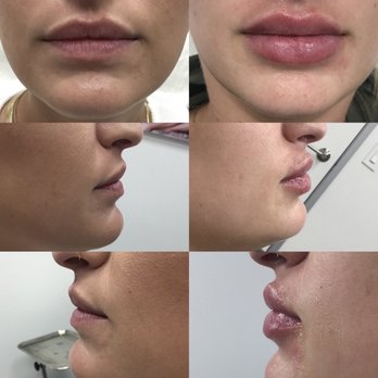 LaserAway - Before and right after. They're obviously swollen and went down a little bit in a day or two. - Laser Hair Removal Near Me - Walnut Creek, California