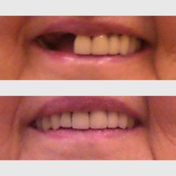 Mitchell Esral, DMD - Esral Dental - "Invisible" Partial Denture