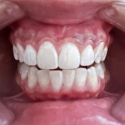 SunRisa Teeth Whitening
