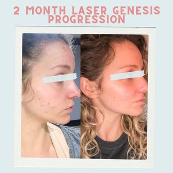 MedSpaPGH - A non-invasive and comfortable laser procedure is used to fade scarring, redness, broken blood vessels, and improve the look of rosacea! - Laser Hair Removal Near Me - North Huntingdon, Pennsylvania MedSpaPGH - A non-invasive and comfortable laser procedure is used to fade scarring, redness, broken blood vessels, and improve the look of rosacea! - Laser Hair Removal Near Me - North Huntingdon, Pennsylvania