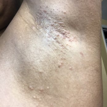 ChiChi Nails & Spa - Both underarms are SUPER ITCHY!! - Nail Salons Near Me - Riverside, California ChiChi Nails & Spa - Both underarms are SUPER ITCHY!! - Nail Salons Near Me - Riverside, California