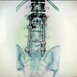 Gary S Shapiro MD - Unstable fusion showing the left rod bowing out leveraging the S1 screw loose