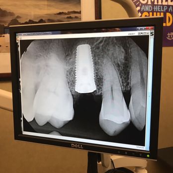 La Costa Dental Excellence - My new titanium post! One more screw to n my head! I'm a little screwy!! - General Dentistry Near Me - Carlsbad, California La Costa Dental Excellence - My new titanium post! One more screw to n my head! I'm a little screwy!! - General Dentistry Near Me - Carlsbad, California