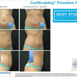 Glendale Body Studio - Coolsculpting Abdomen Before and After