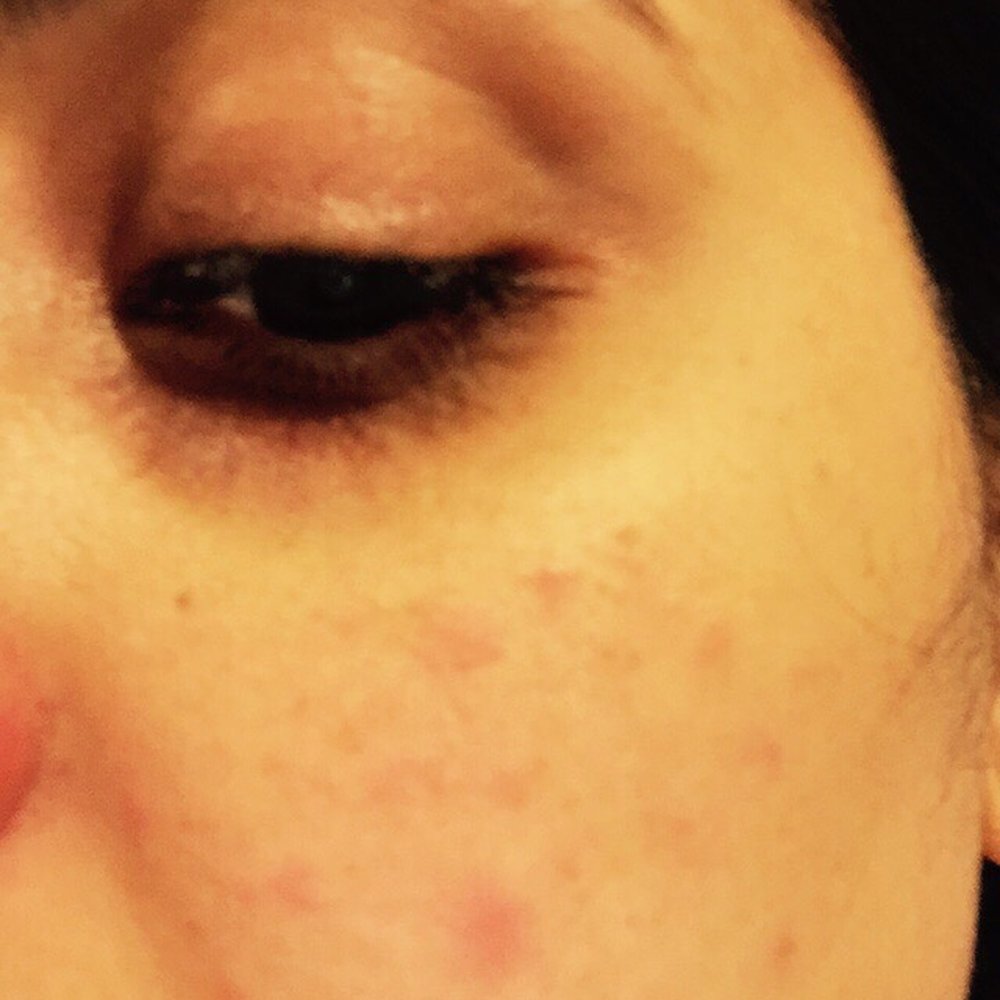 Allergic reaction due to Facial Allergic reaction due to Facial