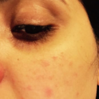 Still Spa at the Woodmark - Allergic reaction due to Facial - Day Spas Near Me - Kirkland, Washington Still Spa at the Woodmark - Allergic reaction due to Facial - Day Spas Near Me - Kirkland, Washington