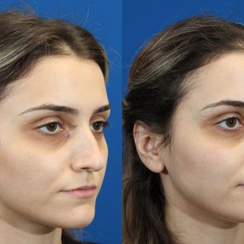 Eric Yavrouian, MD - One year post op rhinoplasty - Ear Nose & Throat Near Me - Glendale, California Eric Yavrouian, MD - One year post op rhinoplasty - Ear Nose & Throat Near Me - Glendale, California