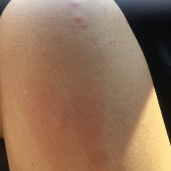 Bites From Bed Bugs Found Little Yellow Seeds Like Larvae In The