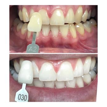 Posh Dental - Before and after with KOR TEETH WHITENING !! - General Dentistry Near Me - Temecula, California