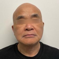Jeffrey S Yager M D - 3 weeks After facelift by Dr. Yager. Very happy.