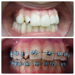 Calismile Orthodontics - Orthodontic treatment for children, teens, and adults - Sherman Oaks, Reseda, Tarzana