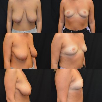 Michael Baroody, MD - Breast Reduction before & after - Cosmetic Surgeons Near Me - Danbury, Connecticut Michael Baroody, MD - Breast Reduction before & after - Cosmetic Surgeons Near Me - Danbury, Connecticut